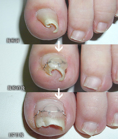 巻き爪の治療が大阪で出来る病院はどこ 巻き爪治療を大阪で探す